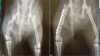 Imagerie scanner d'une fracture